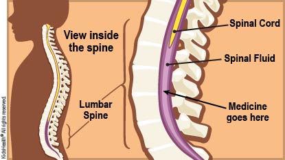 A side view of the bones of the spine are shown inside a young child. Close-up illustration shows the spinal bones, the spinal cord and the space beneath the spinal cord. Shows where the medicine will be placed.